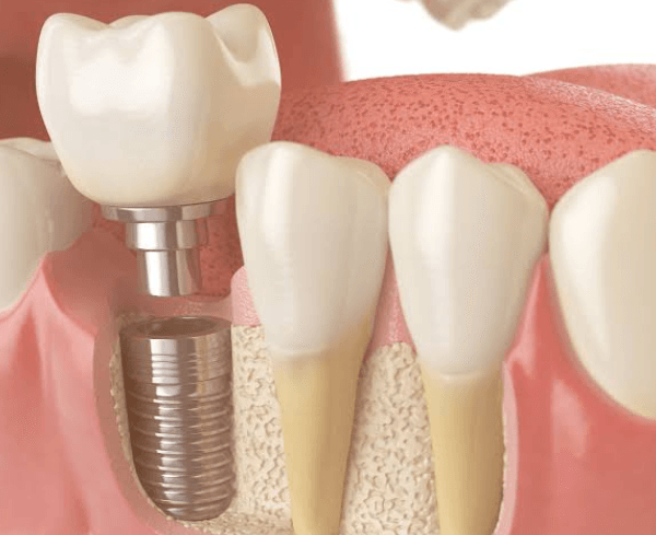 The Role Of Bone Grafting In Successful Implant Placement