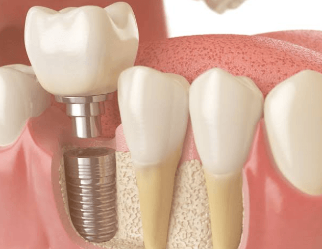The Role Of Bone Grafting In Successful Implant Placement
